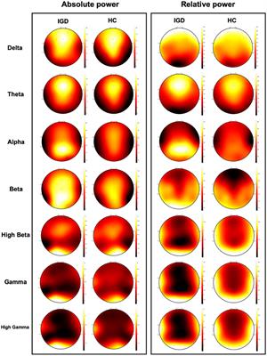 Multiple-Kernel Support Vector Machine for Predicting Internet Gaming Disorder Using Multimodal Fusion of PET, EEG, and Clinical Features